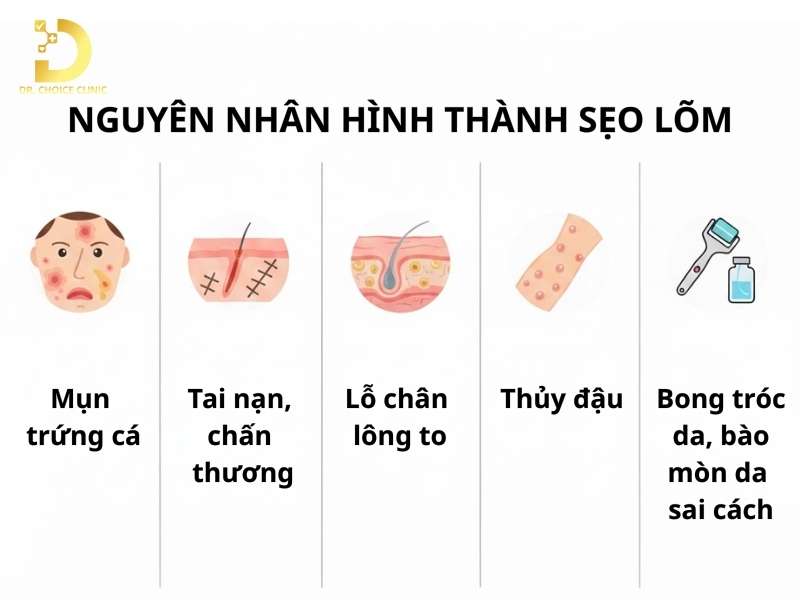 Sẹo rỗ hình thành do đâu?