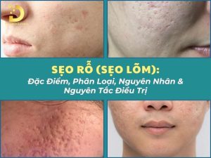 Sẹo rỗ (sẹo lõm)