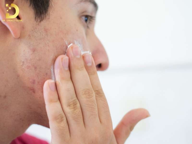 Skincare cho da mụn theo từng tình trạng da