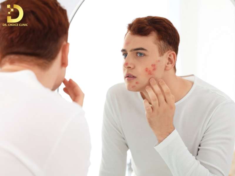 Skincare có thay thế điều trị mụn không?