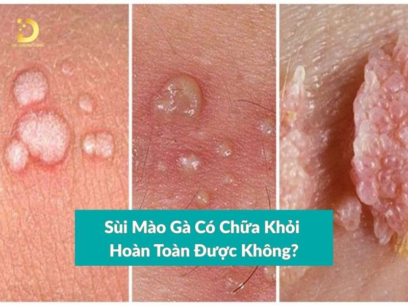 Sùi Mào Gà Có Hết Không? Cách Chữa Sùi Mào Gà Hiệu Quả 10 Sùi mào gà có chữa khỏi hoàn toàn được không?