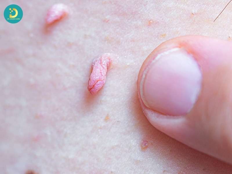 Sùi Mào Gà Trẻ Em: Nguyên Nhân, Dấu Hiệu, Cách Điều Trị & Phòng Ngừa 9 Sùi mào gà ở trẻ có nguy hiểm không?