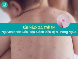 Sùi mào gà trẻ em