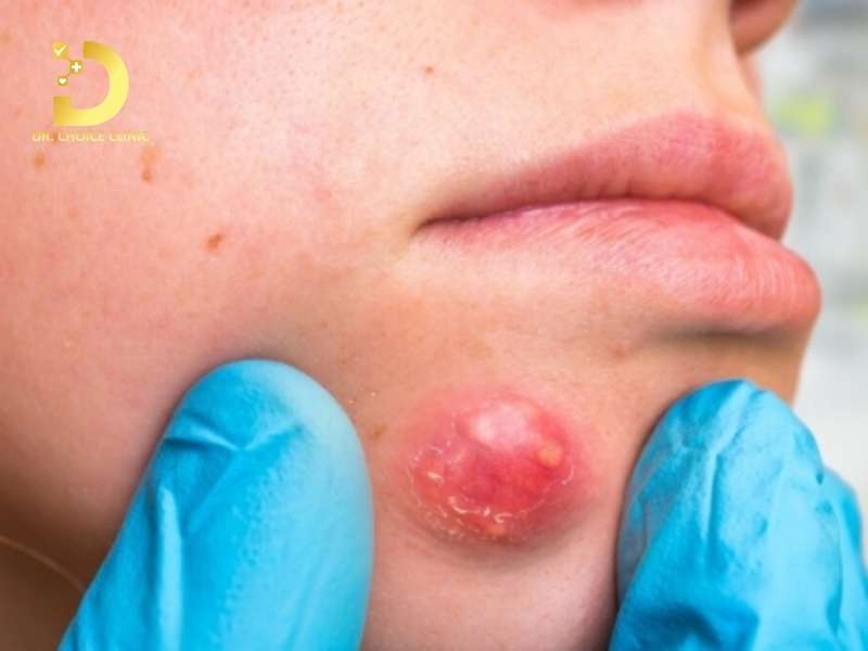 Tại sao tự ý nặn mụn áp xe tại nhà có thể dẫn đến nhiễm trùng máu?