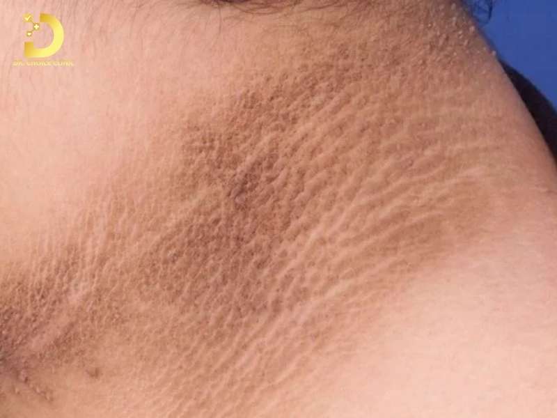 Thâm Cổ: Nguyên Nhân & Cách Điều Trị Nhanh, Hiệu Quả Nhất 9 Thâm cổ là gì?