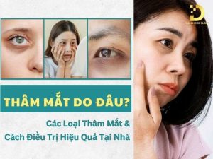 Thâm mắt do đâu?