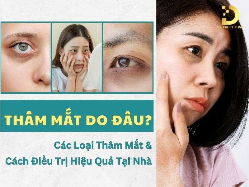 Thâm Mắt Do Đâu? Các Loại Thâm Mắt & Cách Điều Trị Hiệu Quả Tại Nhà 8 Thâm mắt do đâu?