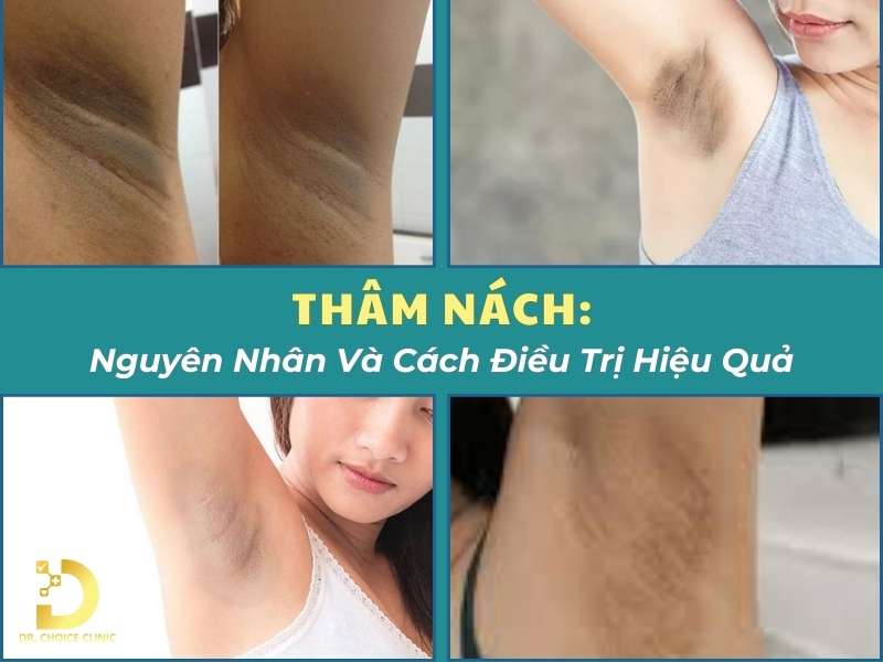 Thâm nách: nguyên nhân và cách điều trị hiệu quả