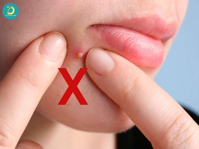 Thói quen sinh hoạt ảnh hưởng trực tiếp đến mụn mủ