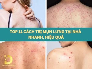 Cách trị mụn lưng tại nhà