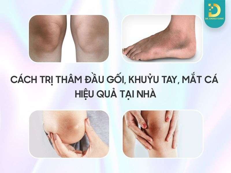 Top cách trị thâm đầu gối, khuỷu tay, mắt cá 