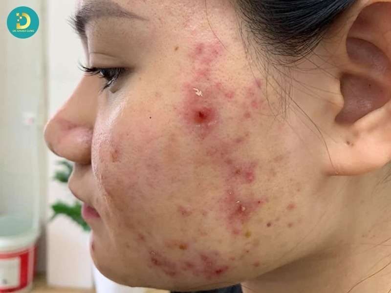 Trường hợp mụn và làn da không nên xông hơi