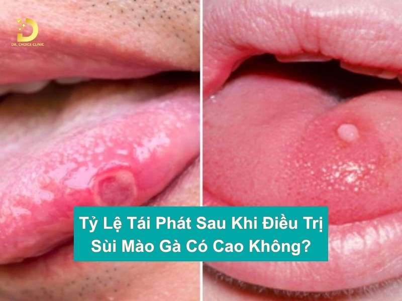 Sùi Mào Gà Có Hết Không? Cách Chữa Sùi Mào Gà Hiệu Quả 13 Tỷ lệ tái phát sau khi điều trị sùi mào gà có cao không?