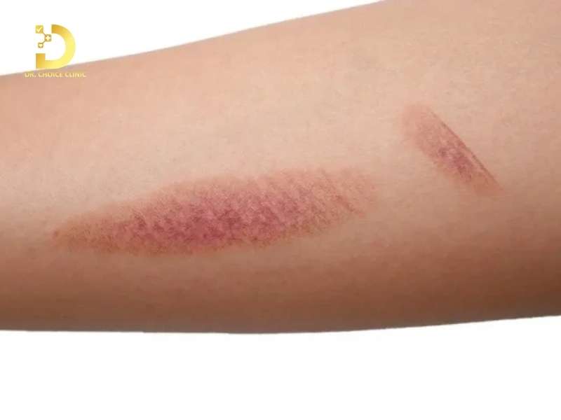 Vết thương lành nhưng da non bị thâm do đâu?