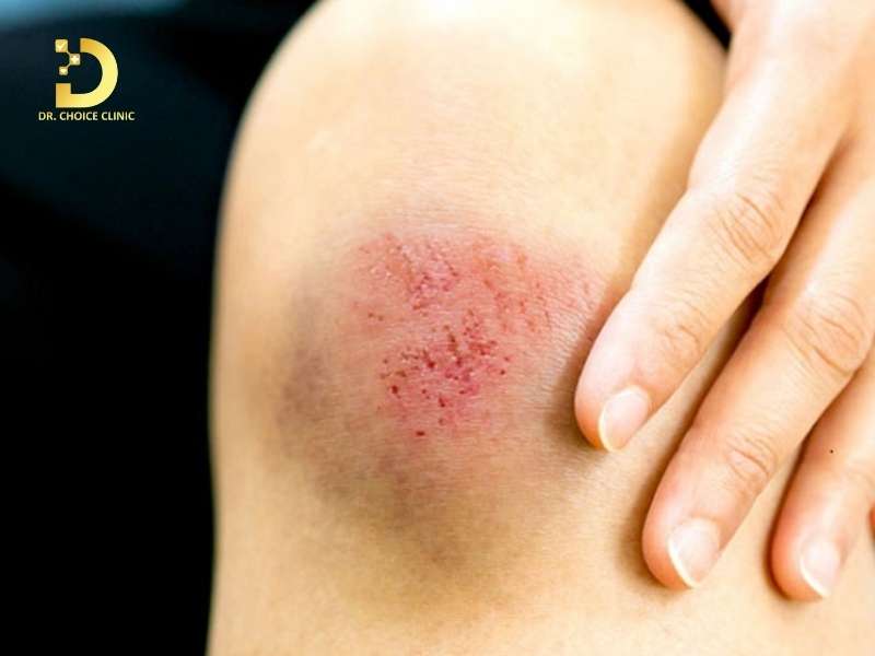 Vết thương lên da non bị thâm là gì?