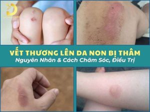 Vết thương lên da non bị thâm