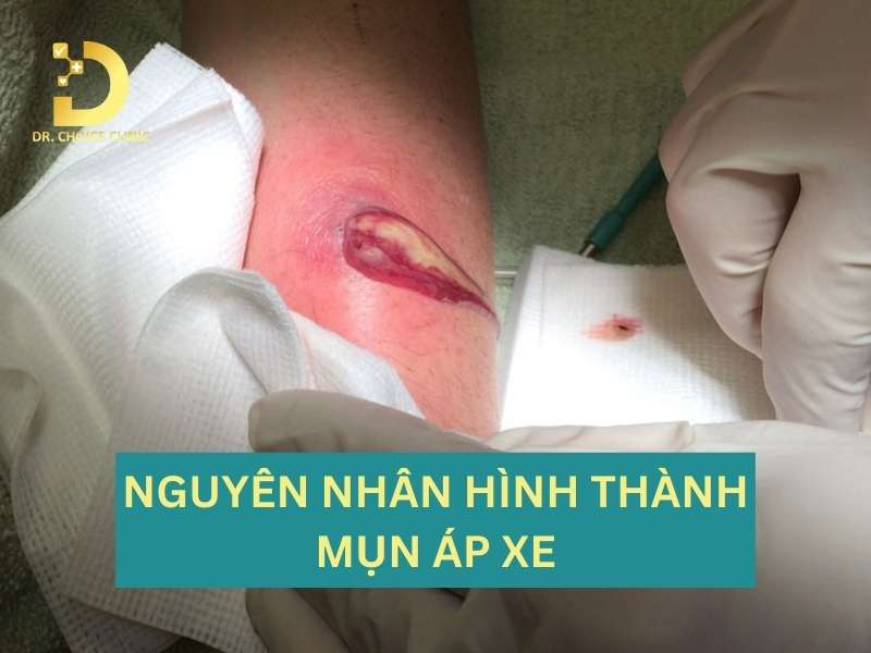Vì sao bị mụn áp xe?