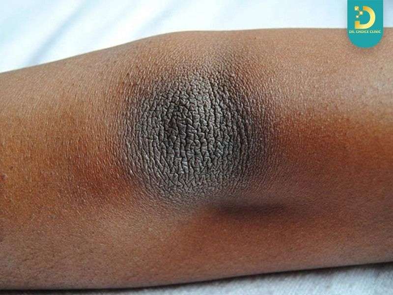 Trị thâm mãi không hiệu quả dù đã chăm sóc đúng cách