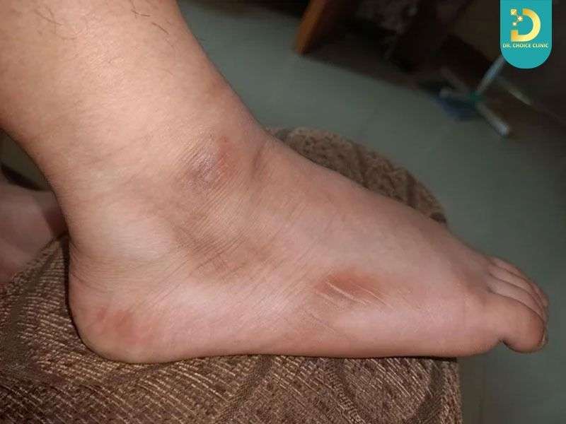 Nguyên nhân nào khiến đầu gối, khuỷu tay, mắt cá bị thâm sạm kéo dài?