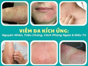 Viêm da kích ứng