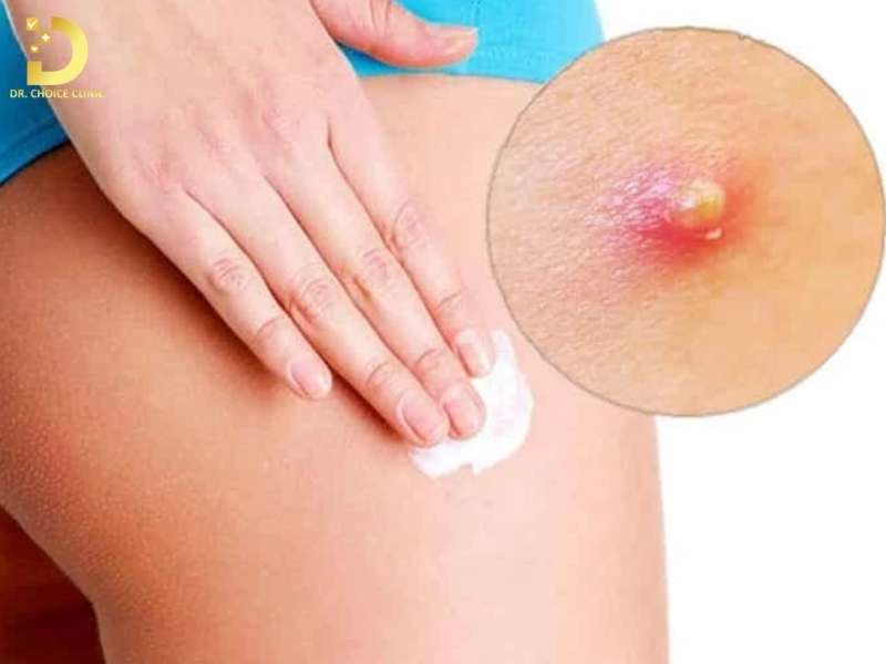 Những điều nên tránh khi tự xử lý mụn mông tại nhà