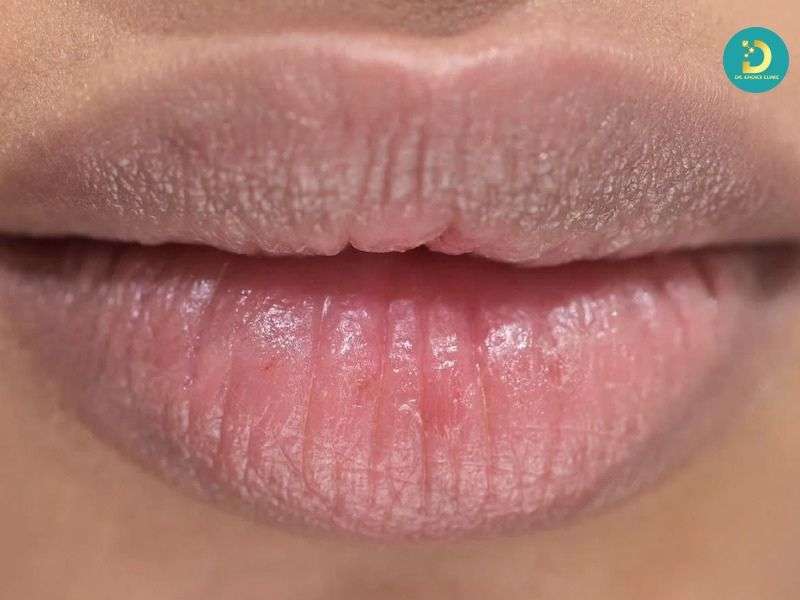 Môi Thâm: Nguyên Nhân & Cách Điều Trị Hiệu Quả 11 Yếu tố nội sinh: cơ địa, di truyền và bệnh lý mạn tính