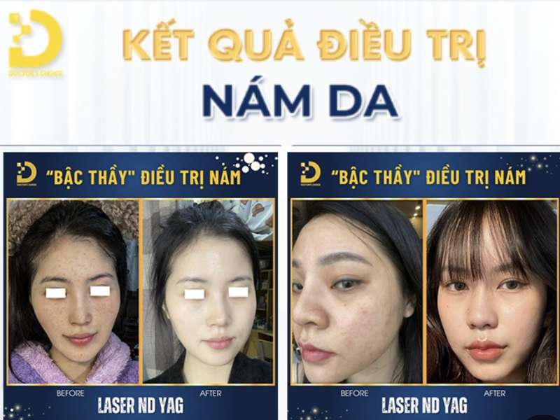 Đơn vị nào cung cấp dịch vụ điều trị nám nội tiết uy tín tại Hồ Chí Minh?