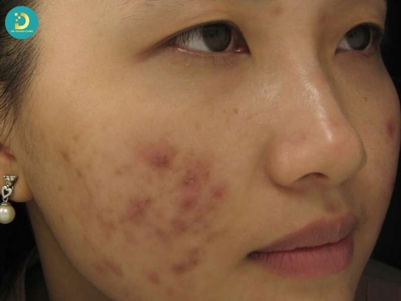 Ảnh hưởng của nặn mụn đến nang lông, trung bì và hàng rào da