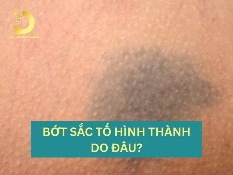 Bớt sắc tố hình thành do đâu và khi nào cần thăm khám y khoa?