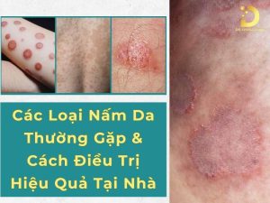 Các loại nấm da thường gặp