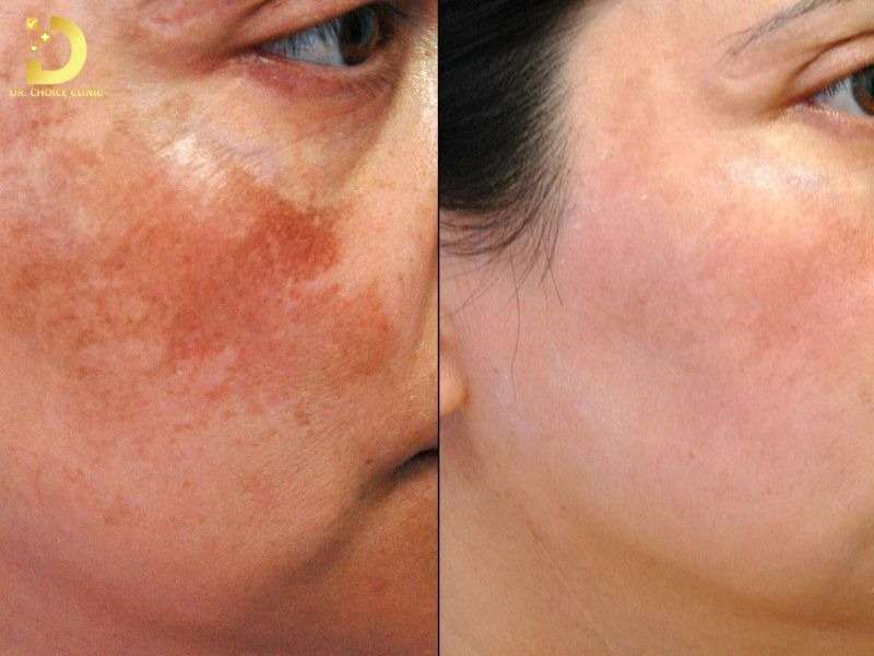 Các phương pháp điều trị nám chuyên sâu