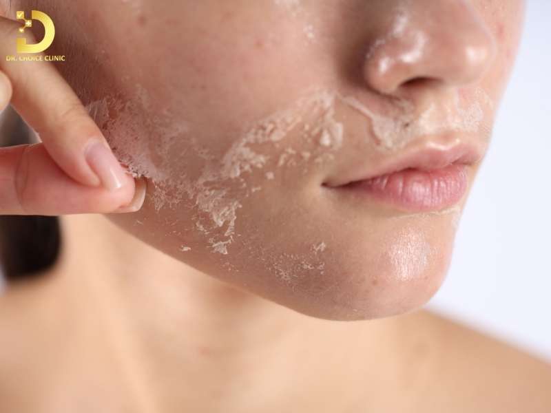 Các vấn đề thường gặp ở da khô là gì?