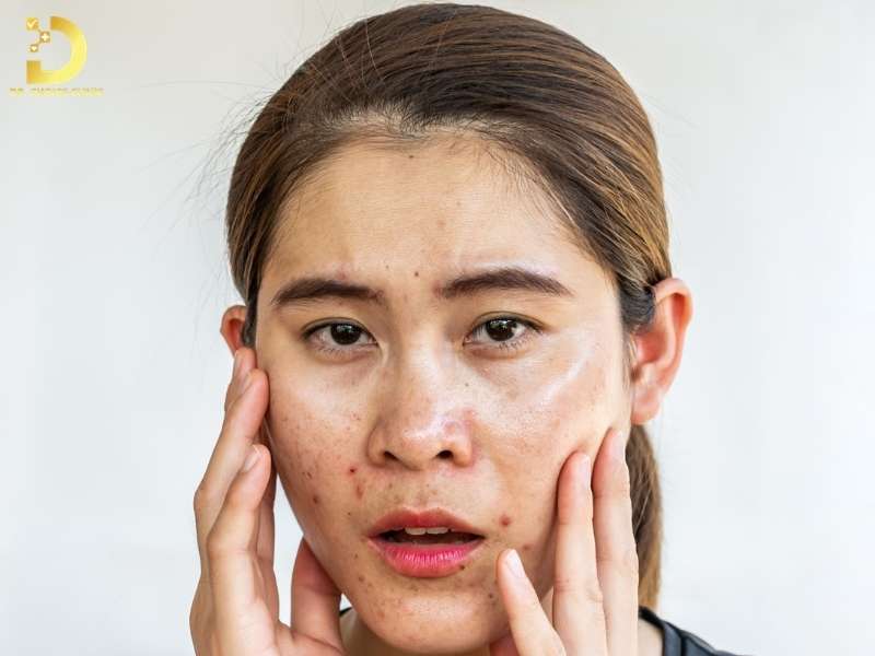 Các vấn đề thường gặp ở làn da dầu