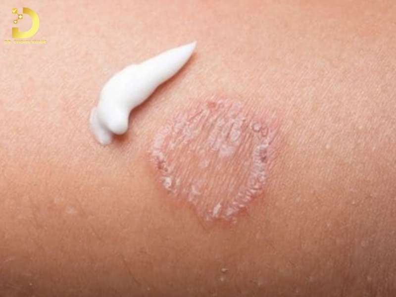 Cách điều trị nấm da hiệu quả tại nhà