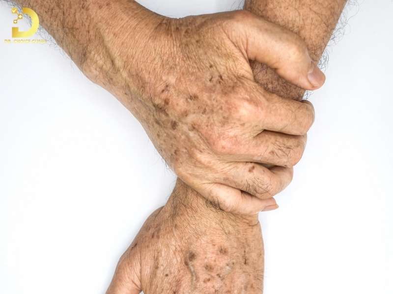 Đồi Mồi: Dấu Hiệu, Nguyên Nhân & Cách Điều Trị Hiệu Quả 12 Dấu hiệu nhận biết đồi mồi trên da