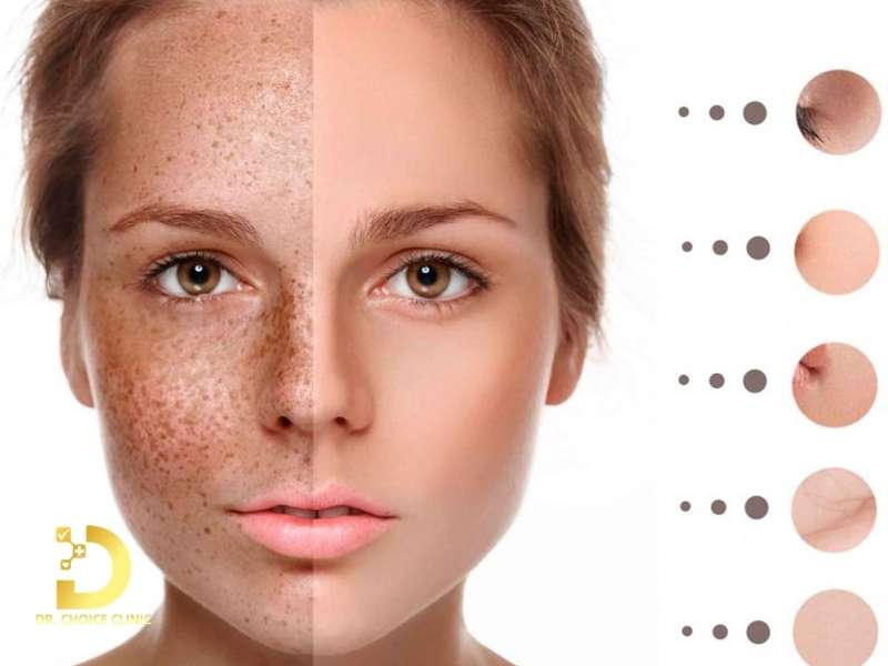 Dấu hiệu nhận biết tàn nhang là gì?