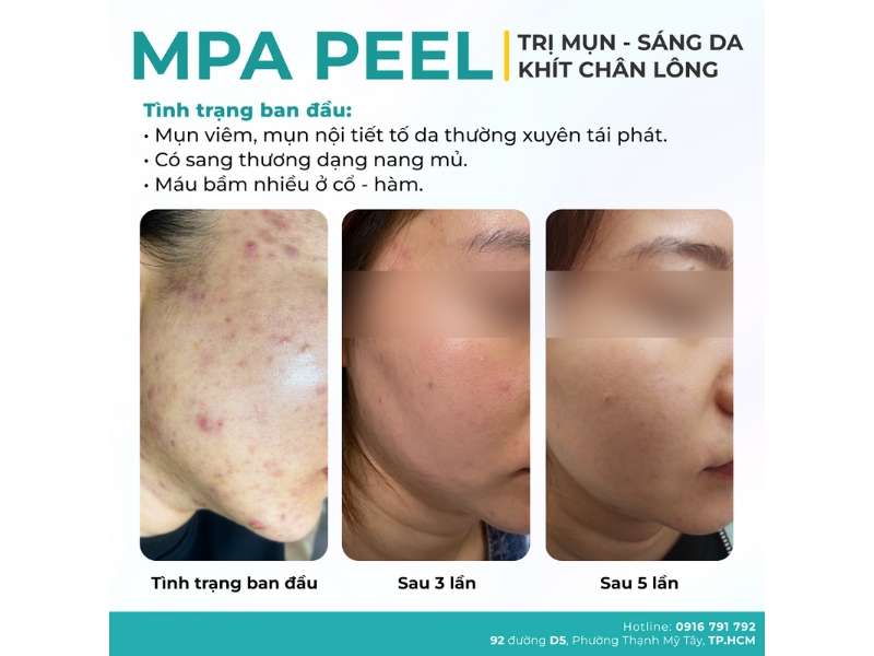 Địa chỉ nào lấy nhân mụn an toàn, chuẩn y khoa tại HCM?