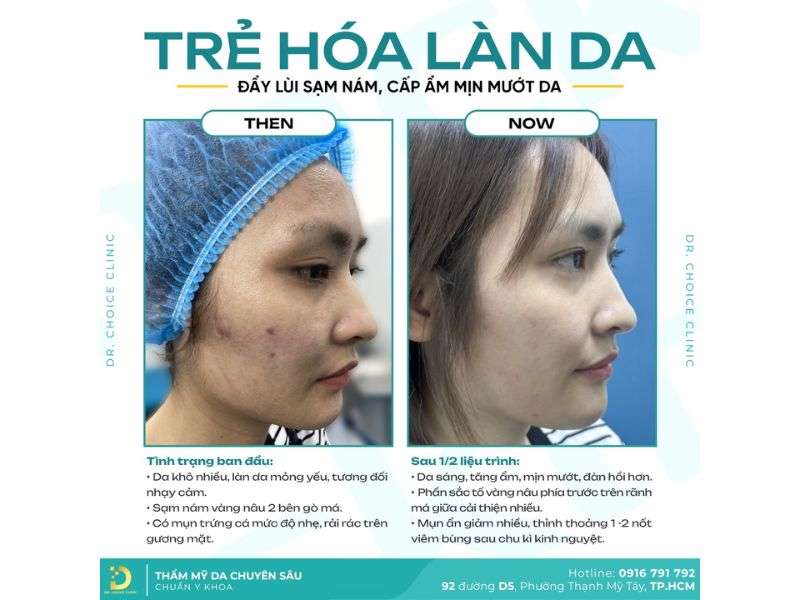 Nếp Nhăn: Nguyên Nhân, Biểu Hiện & Phương Pháp Cải Thiện Hiệu Quả 15 Địa chỉ nào xóa nếp nhăn an toàn, hiệu quả tại HCM?