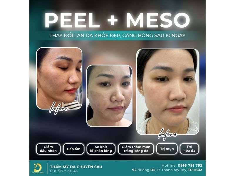 Nếp Nhăn: Nguyên Nhân, Biểu Hiện & Phương Pháp Cải Thiện Hiệu Quả 14 Địa chỉ nào xóa nếp nhăn an toàn, hiệu quả tại HCM?