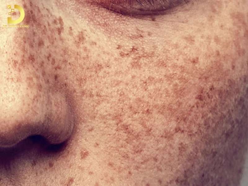 Đồi Mồi: Dấu Hiệu, Nguyên Nhân & Cách Điều Trị Hiệu Quả 11 Đồi mồi là gì? góc nhìn da liễu về tình trạng tăng sắc tố lành tính