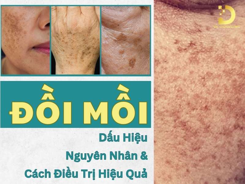 Đồi Mồi: Dấu Hiệu, Nguyên Nhân & Cách Điều Trị Hiệu Quả 10 Đồi mồi