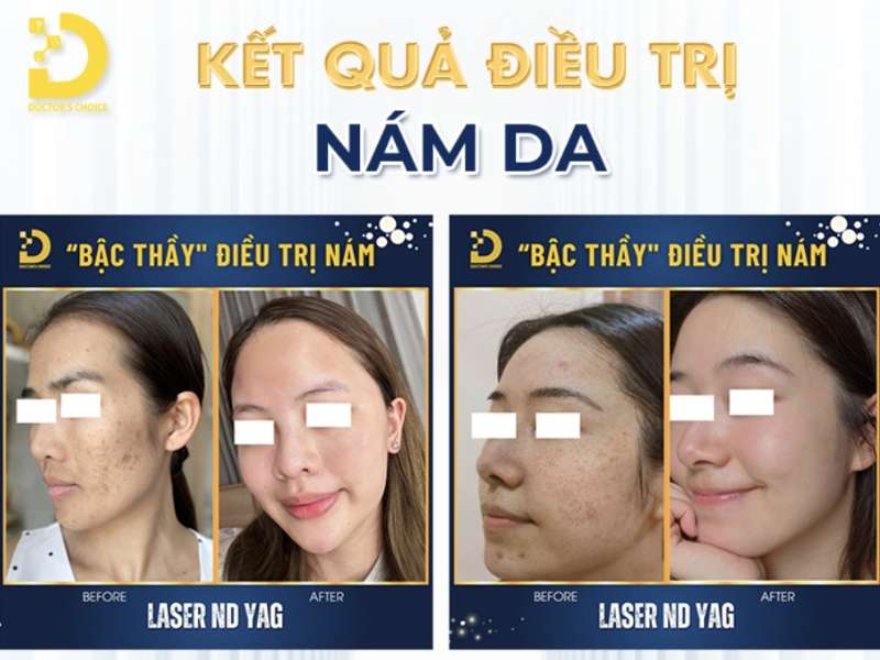 Đơn vị nào cung cấp dịch vụ điều trị nám nội tiết uy tín tại Hồ Chí Minh?
