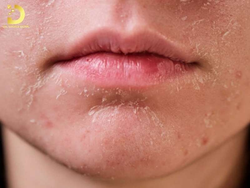 Hiểu đúng về da khô