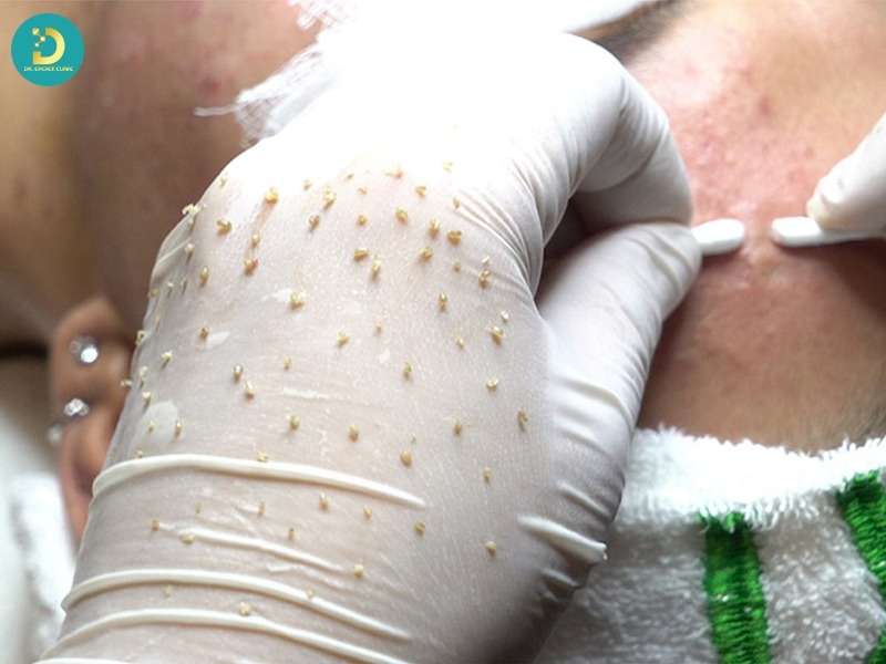 Khi nào nặn mụn có lợi cho da?