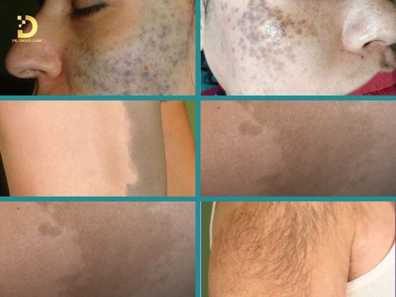 Làm thế nào để nhận biết các loại bớt sắc tố thường gặp trên da?