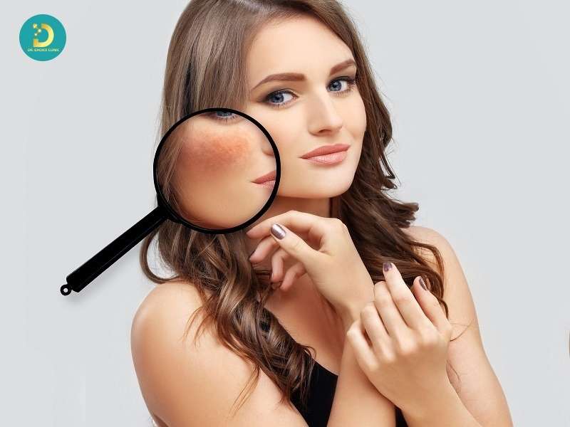 Làm thế nào để nhận biết nám da, tàn nhang, đồi mồi tại nhà?