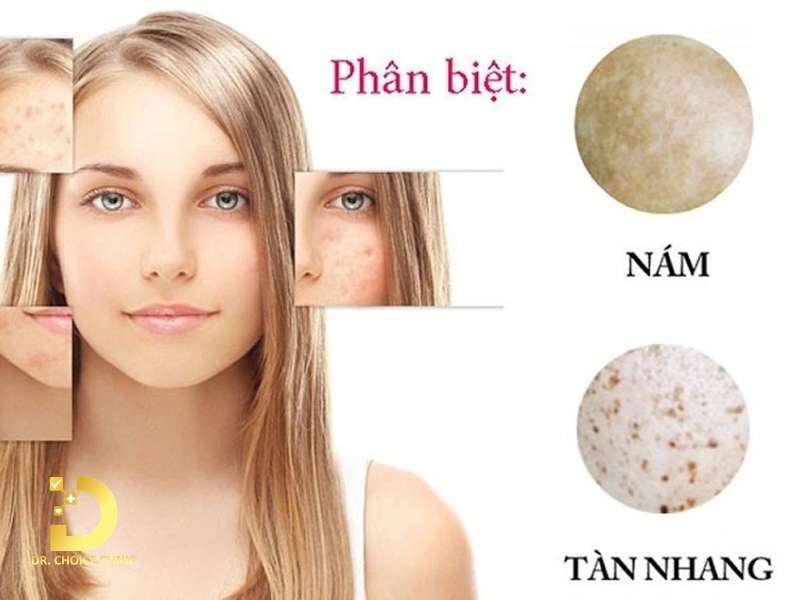 Làm thế nào để phân biệt tàn nhang với nám da và đồi mồi?