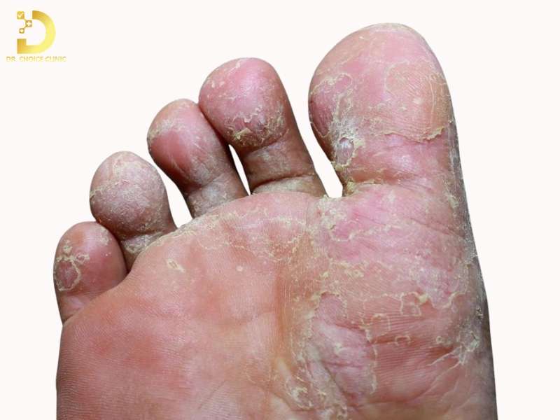 Nấm kẽ (nấm bẹn, nấm kẽ tay – kẽ chân) – Dễ bỏ sót do vị trí tổn thương kín