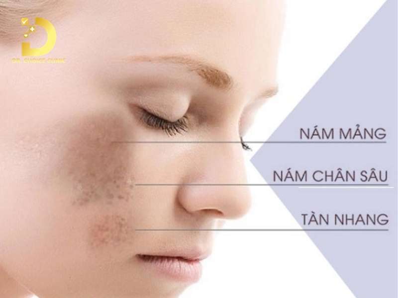 Nám nội tiết là gì và làm thế nào để phân biệt với các loại nám da thông thường?