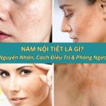Nám nội tiết là gì?
